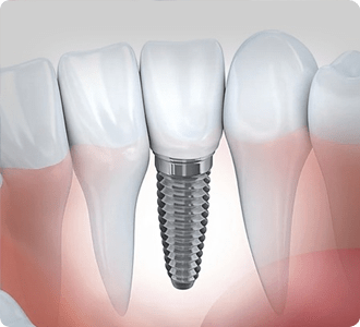 Dental Implants | Grace Family Dental | Airdrie Dentist