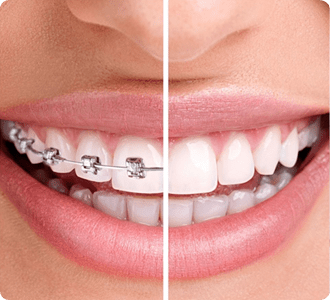 Orthodontic Braces | Grace Family Dental | Airdrie Dentist