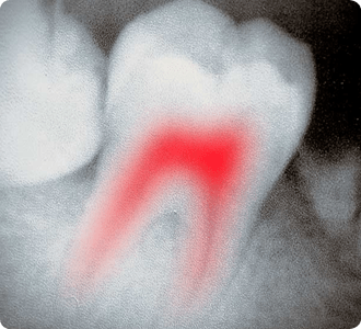 Root Canals | Grace Family Dental | Airdrie Dentist