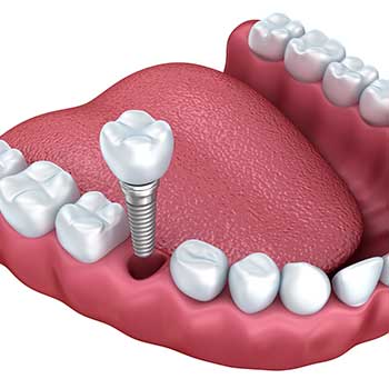 Dental Implants | Grace Family Dental | Airdrie Dentist