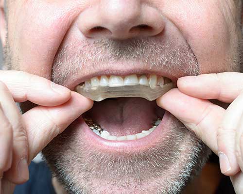 Dental Night Guard | Grace Family Dental | Airdrie Dentist
