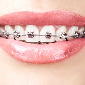 Metal Braces | Grace Family Dental | Airdrie Dentist