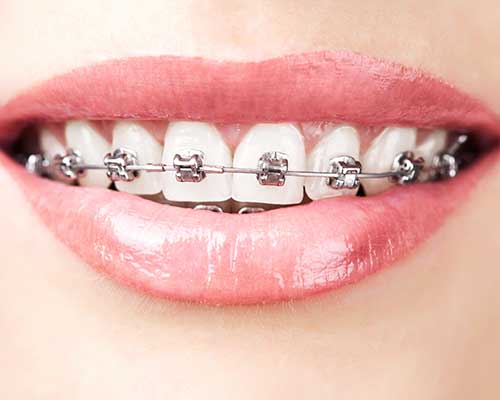 Metal Braces | Grace Family Dental | Airdrie Dentist