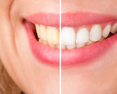 Teeth Whitening | Grace Family Dental | Airdrie Dentist